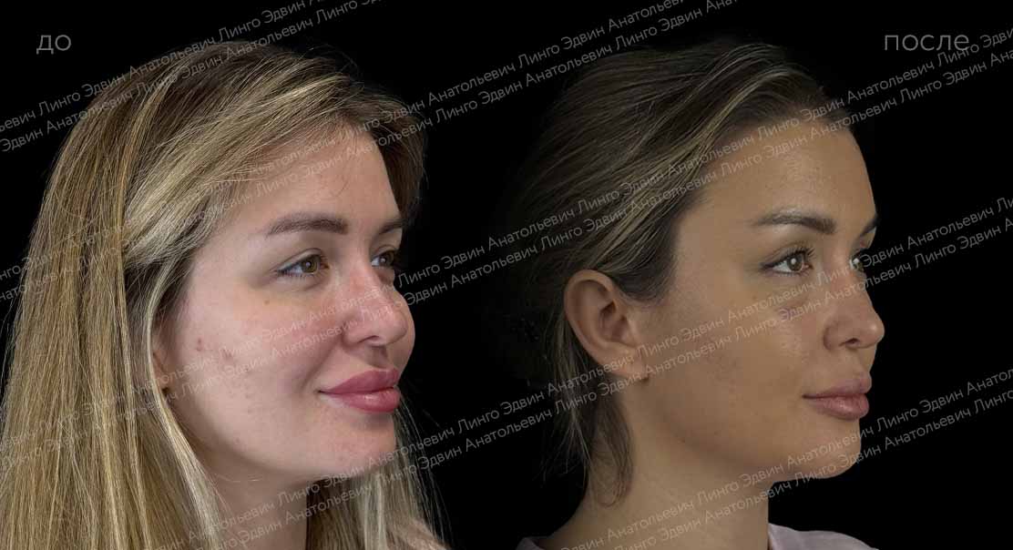 Эндоскопический лобно-височный лифтинг