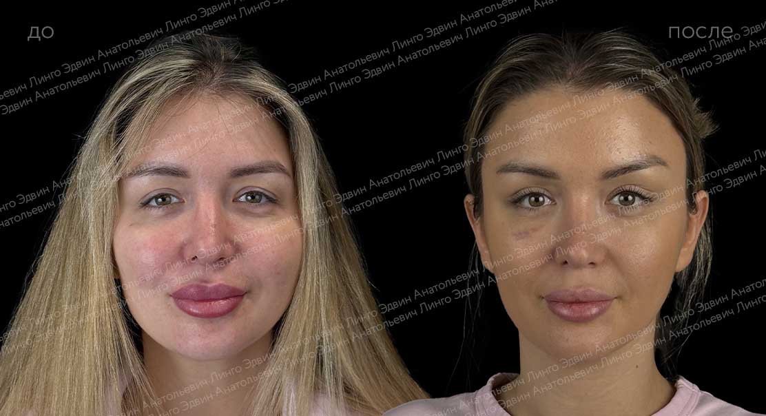 Эндоскопический лобно-височный лифтинг