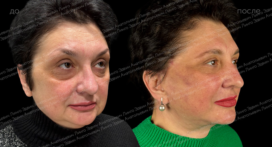 Пластика лица, шеи и век