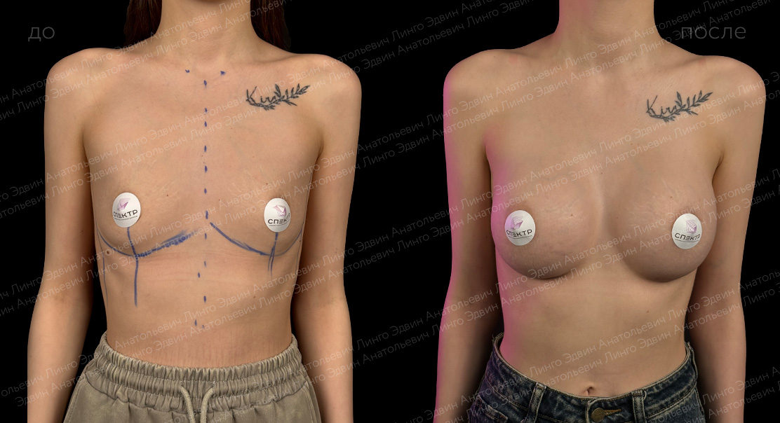 Увеличение груди