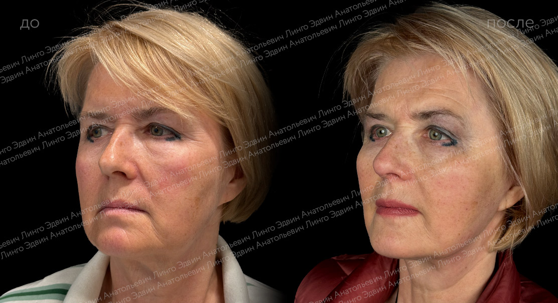 Круговая подтяжка лица